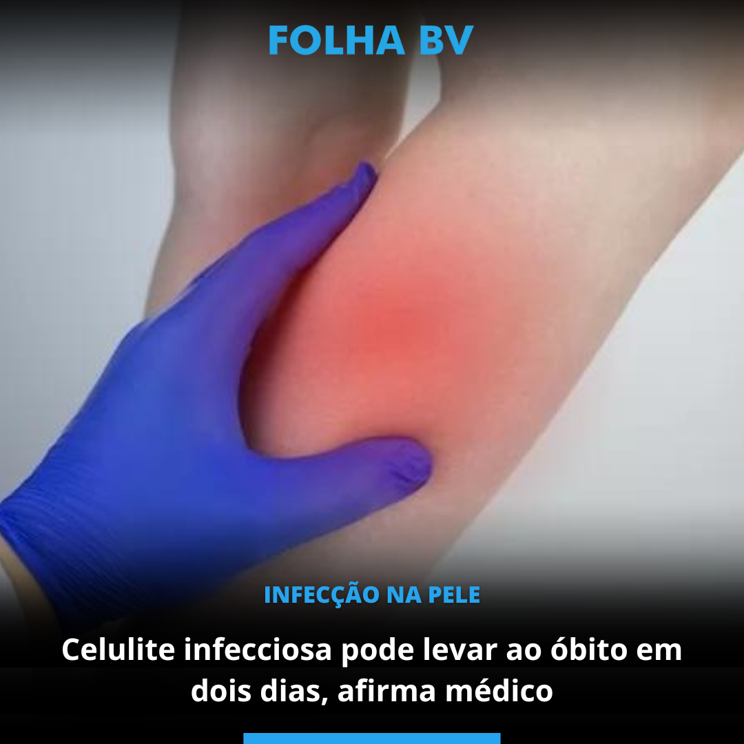 Celulite infecciosa pode levar ao óbito em dois dias, afirma médico