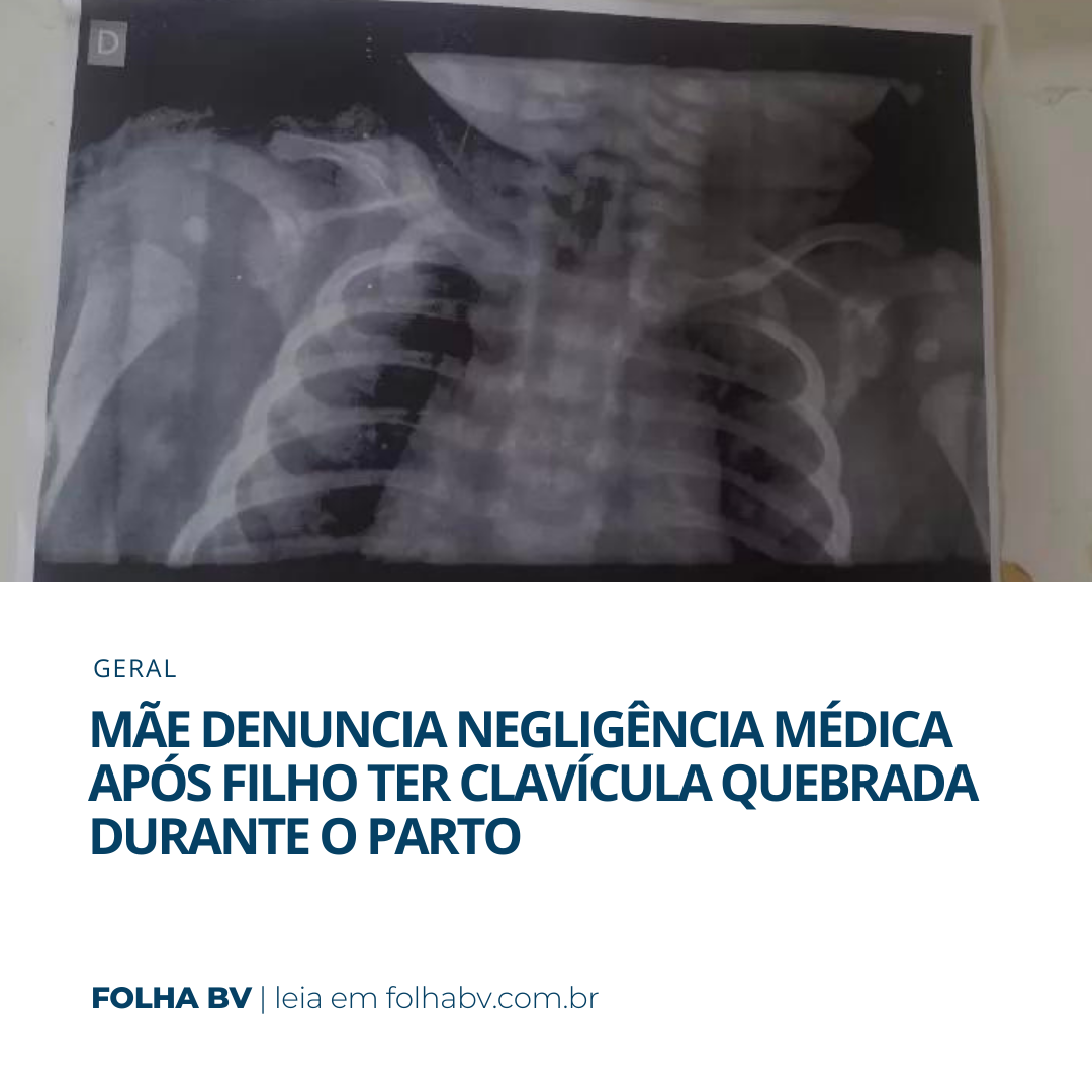 https://www.folhabv.com.br/geral/mae-denuncia-negligencia-medica-apos-filho-ter-clavicula-quebrada-durante-o-parto/