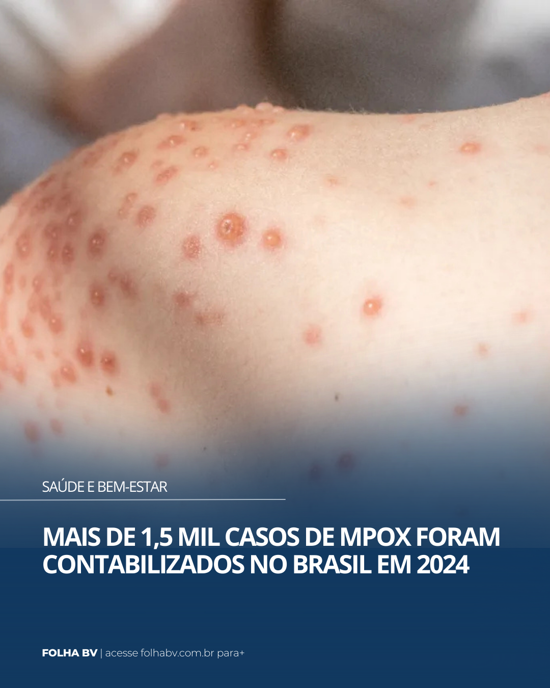 https://www.folhabv.com.br/saude-e-bem-estar/mais-de-15-mil-casos-de-mpox-foram-contabilizados-no-brasil-em-2024/