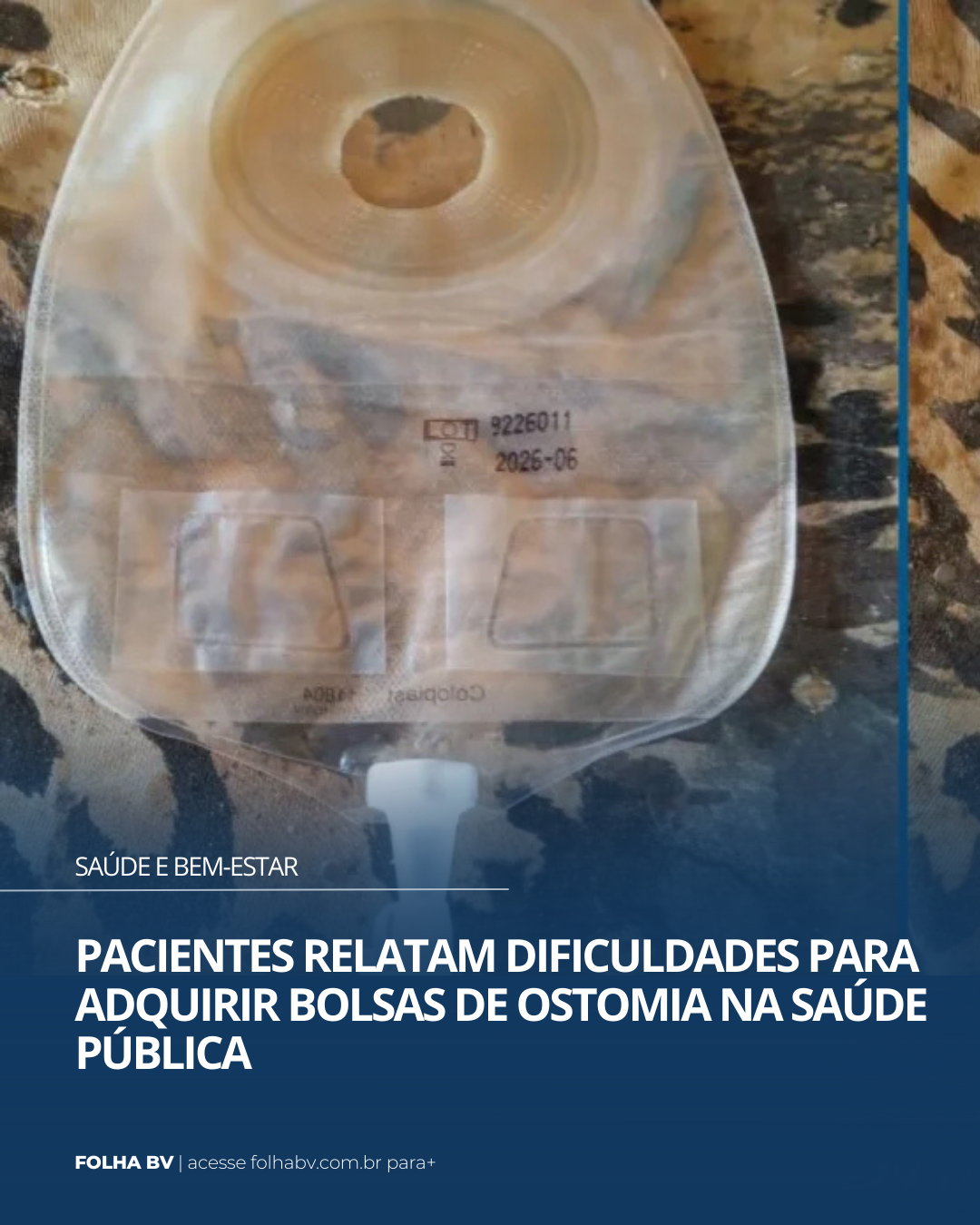https://www.folhabv.com.br/saude-e-bem-estar/pacientes-relatam-dificuldades-para-adquirir-bolsas-de-ostomia-na-saude-publica/