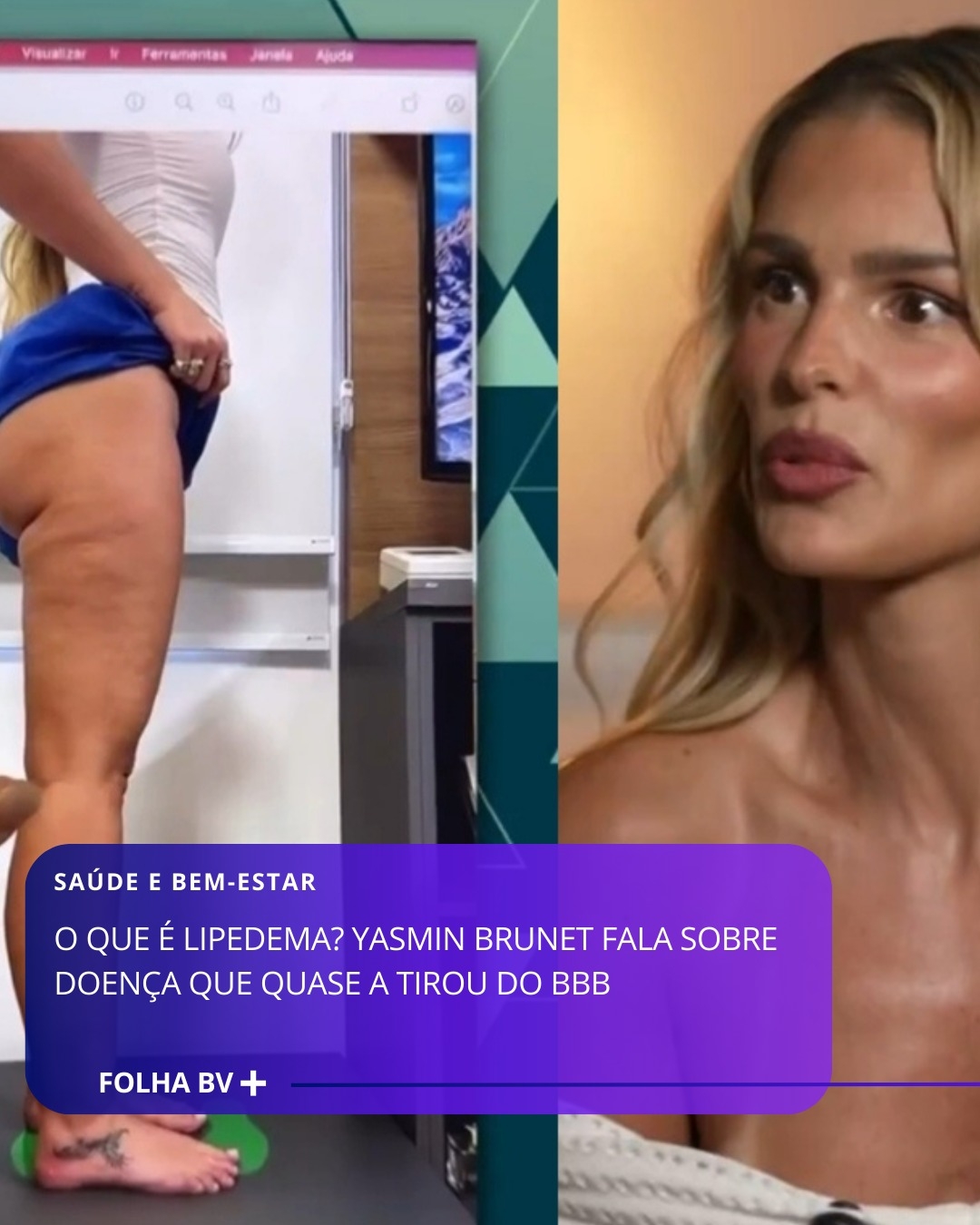 https://www.folhabv.com.br/geral/o-que-e-lipedema-yasmin-brunet-fala-sobre-doenca-que-quase-a-tirou-do-bbb/